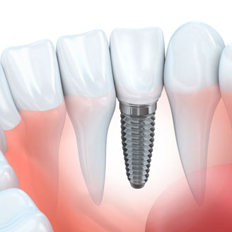 implantes-dentales-clinicadentalalmansa