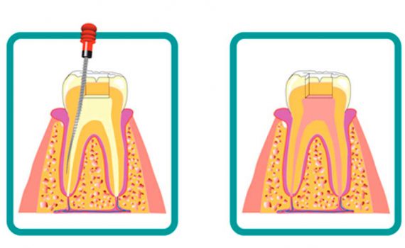 endodoncia-avanzada