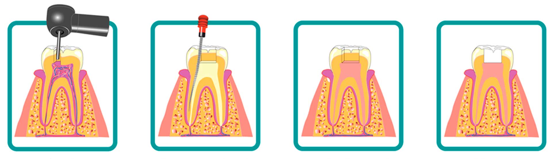 endodoncia-avanzada