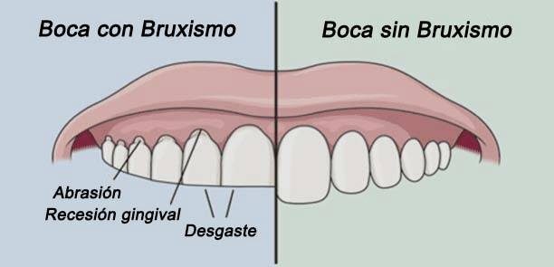 Bruxismo y férula de descarga. En qué consiste y cómo se utiliza